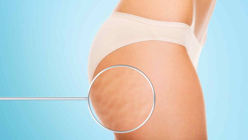 6 Exercices Faciles Pour Perdre Sa Cellulite En Seulement 2 Semaines.